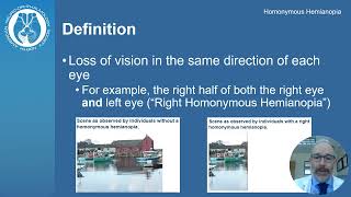 Understanding Homonymous Hemianopia Causes Symptoms and Treatment  Visual Impairment Explained [upl. by Ozmo]