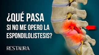 ¿Qué pasa si no me opero la espondilolistesis [upl. by Aivax403]