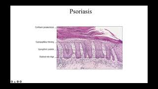 Psoriasiform reaction patterns [upl. by Eliga539]