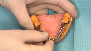 V2551  Predictable Removable Partial Dentures [upl. by Ezechiel]