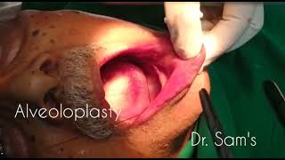 Alveoloplasty Surgery  Ridge remodelling for Denture Placement [upl. by Ennovehc]