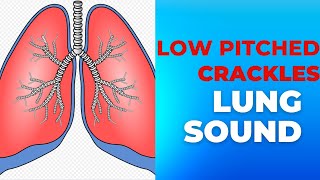 Low pitched Crackles Lung Sounds Collection EMPTprep [upl. by Aztiraj862]