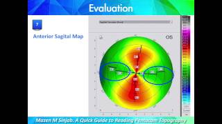 A Quick Guide to Reading Corneal Topography Part 1 [upl. by Aneis386]