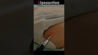 Liposuction procedure in 3D animation shorts viral [upl. by Stroud598]