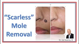 Mole Removal the Easy Way [upl. by Conrade]