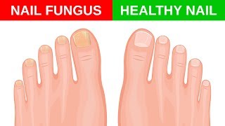 Simple Home Remedies for Toenail Fungus [upl. by Arotak]