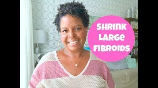 HOW TO SHRINK LARGE FIBROIDS NATURALLY  3 TIPS  By What Chelsea Eats [upl. by Attener]