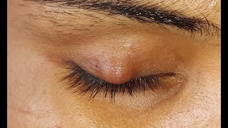 Chalazion Incision amp Curettage HD [upl. by Towney961]