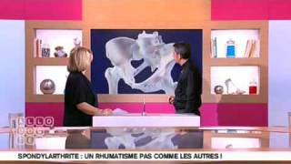 Présentation de la Spondylarthrite Ankylosante [upl. by Thissa]