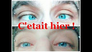 Lendemain doperation du strabismeTOUT VA BIEN strabismus operation [upl. by Henarat]