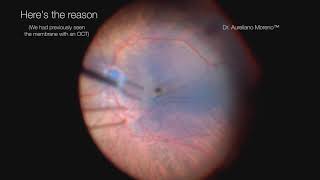 Patient with mild and thin epiretinal membrane with 2020 vision but complained of distortion [upl. by Cheyne]