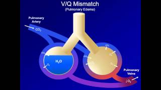 Hypoxia and Hypoxemia Mechanisms and Etiologies ABG Interpretation  Lesson 18 [upl. by Nagiam630]