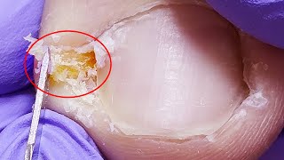 Decompressed Ingrown toenails deeply embedded in the flesh perfect removalnails pedicure [upl. by Pegeen]