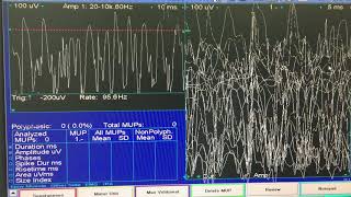 Myotonia and myotonic EMG discharges [upl. by Hairem]