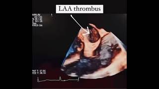 How LAA Thrombus appears on 3D echocardiogram  The echo channel [upl. by Nemra]