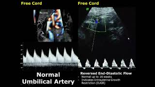 Umbilical Artery Doppler Ultrasound Normal Vs Abnormal Image Appearances  Spectral Doppler USG [upl. by Salaidh]