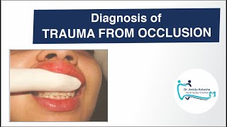 Diagnosis of TRAUMA FROM OCCLUSION TFOCLINICALRADIOGRAPHICFREMITUS TESTDR ANKITA KOTECHA [upl. by Ferd]