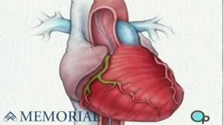 Cardiac Catheterization Angiography [upl. by Aicileb220]