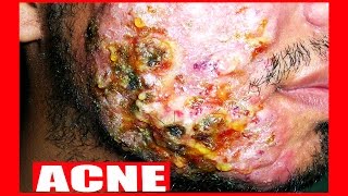 Giant Blackhead Squeezed  Giant Blackhead Removal [upl. by Kalagher116]