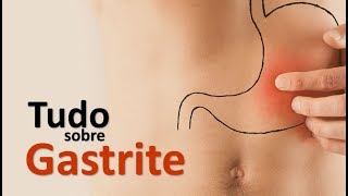 TUDO SOBRE GASTRITE  SINAIS SINTOMAS E TRATAMENTO  Dr Marcelo Lima [upl. by Grannias]