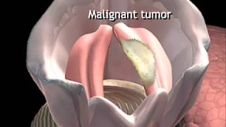 What Causes Vocal Cord Cancer Animation  Malignant Tumors of Throat or Larynx Video [upl. by Theola]