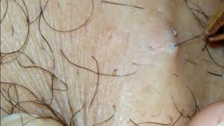 long and GROSS Huge Ingrown hair removal 2019ingrown hair treatment [upl. by Newcomer]