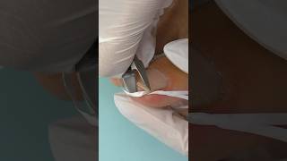 INGROWN TOENAIL 🦶 hack DIY  Worked for Me [upl. by Namzzaj11]