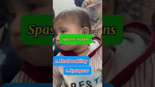 Spasmus nutans syndrome  Head nodding in babies [upl. by Amiel]