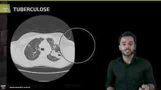 Padrões na tomografia de tórax  Aula de Radiologia SanarFlix [upl. by Goldi]