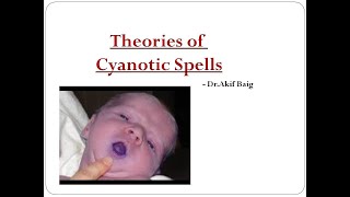 Theories of Cyanotic Spells  Dr Akif Baig [upl. by Dollie]