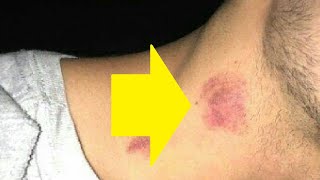 how to give someone a hickey fast for beginners [upl. by Yevad]