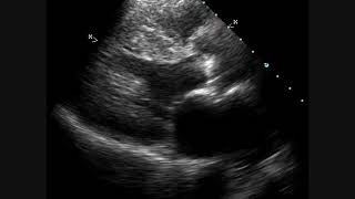 Calcific Aortic Stenosis  Echocardiogram [upl. by Carena]