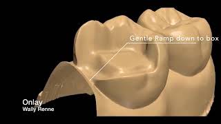 Posterior tooth preparations inlay onlay crownlayfixed [upl. by Jock]