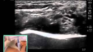 ULTRASOUNDGUIDED SUPRACLAVICULAR NERVE BLOCK [upl. by Ailido]