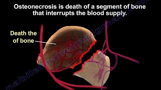 Osteonecrosis AVN Of The Talus  Everything You Need To Know  Dr Nabil Ebraheim [upl. by Kusin103]