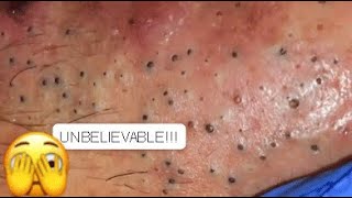 Super Removal Of Big Deep Blackheads On Nose  New [upl. by Fonseca]