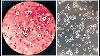 Cryptococcus neoformans Meningoencephalitis [upl. by Oicam]