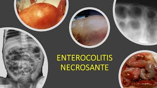 Enterocolitis necrosante [upl. by Ibrik615]