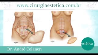 Abdominoplastia Miniabdominoplastia Como são Diferenças TV Gazeta [upl. by Cirdor927]