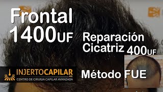 Transplante Capilar x técnica FUE 1800 UF [upl. by Eniloj704]