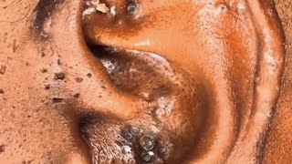 Black ear pimples blackhead pimple pimplepopping acne asmr [upl. by Attesoj]