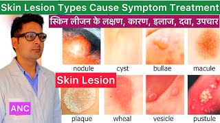 Skin Lesions Cause Symptom Diagnosis Treatment in Hindi  Skin Lesion  What is Skin Lesion  Skin [upl. by Raynor]