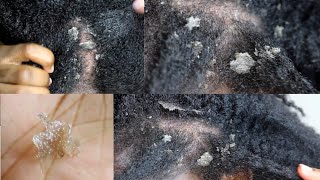 My Seborrheic Dermatitis my scalp up close [upl. by Royd]