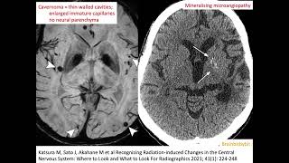 67 Radiation induced cavernoma and mineralising microangiopathy popcorn capillary teleangiectasia [upl. by Ari]