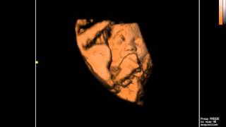 Color Doppler Ultrasound Sonoscape S8  Demo of 4D Function [upl. by Struve]