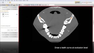 SimPlant 15 Virtual Teeth Design [upl. by Conard]