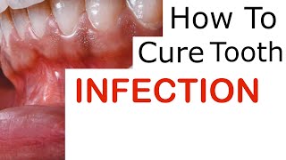 Tooth Infection Explained [upl. by Akeem]