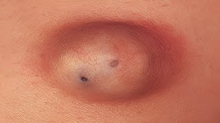 Epidermal Inclusion Cyst [upl. by Krishnah756]