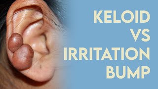 Keloid or Irritation Bump How to fix quotpiercing bumpsquot [upl. by Lanfri]