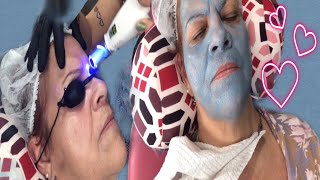 Rejuvenescimento Facial com Caneta Laser Azul Picossegundos [upl. by Dlonra]